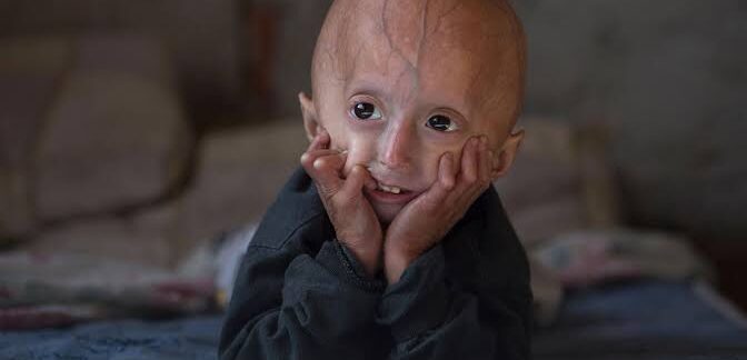 Progeria de Werner : Vieillissement précoce — Comprendre et Agir