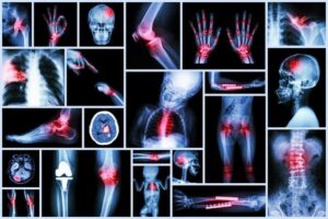 Qu'est-ce que l'insensibilité congénitale à la douleur