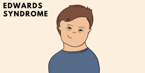 Syndrome d'Edwards : Guide complet