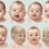 Syndrome de Patau : Tout savoir