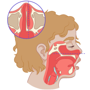 syndrome d'Apert face aux autres craniosténoses syndromiques