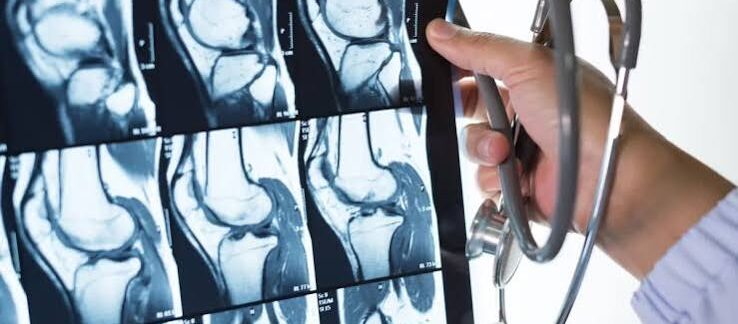 Syndrome de Protée : symptômes, causes et croissance excessive